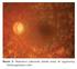 Vitreoretinal Cerrahide Pupiller Membran Gelişimi: Risk Faktörleri ve Klinik Seyir