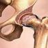 Gelişimsel kalça displazisine bağlı koksartrozlu hastalarda total kalça artroplasti sonuçlarımız