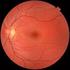 Retina Hastalıklarında Refraksiyon Değişiklikleri