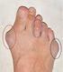 Ayakta küçük parmak deformiteleri