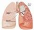 Küçük hücreli dışı akciğer kanserinin altıncı ve yedinci TNM evreleme sistemlerine göre karşılaştırılması