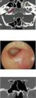 RELATION OF BONY ANATOMIC VARIATIONS WITH THE SINUSITIS SCORES IN PATIENTS WITH CHRONIC SINUSITIS +