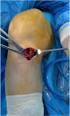 Patellar tendonun yırtıklarının tendon greftiyle tamirinin biyomekaniğinin incelenmesi: Deneysel çalışma