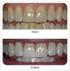 Protez temizleme preparatlarının farklı yapıdaki yapay dişlerin renk stabilitesine etkisi