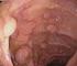 Gastrointestinal poliplerin boyut, lokalizasyon ve histopatolojik tipleriyle değerlendirilmesi