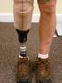 Diz altı amputelerde Türkiye de sıklıkla kullanılan protez ayakların yürüyüş ve ambulasyon aktiviteleri üzerine etkisi