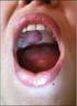 10 year old pleomorphic adenoma on the palate: One year follow-up