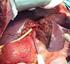 Karaciğer Transplantasyonu
