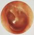 Otit; Otitis Media; Akut Otit; Middle Ear Infection