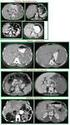Primer hepatik lenfomanın manyetik rezonans görüntüleme bulguları