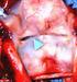 OUR SURGICAL APPROACH TO THE EARLY STAGE (T1) GLOTTIC CARCINOMA INVADING ANTERIOR COMMISSURE Functional results
