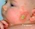 Atopik dermatit tanı yaşının ek alerjik hastalık gelişimi üzerine etkisi