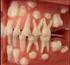 GİRİŞ Diş çürüğü, karyojenik bakterilerin besin maddelerini fermente edip, asit oluşturması ve oluşan asitlerin plak aracılığı ile diş yüzeyini etkile