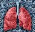 Akciğer Kanserinin Evrelenmesi
