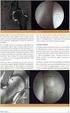 Tip 2 superior labrum anterior posterior lezyonlar n n artroskopik tedavisi