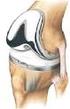 Comparison of Range of Motion After Total Knee Prosthesis According to Different Type of Prosthesis