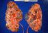 Extrarenal Manifestations in Autosomal Dominant Polycystic Kidney Disease