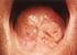 Tiroid Glandının Malign Neoplazmları