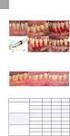 7tepeklinik. Periodontal apsenin kombine periodontal tedavisi: Bir olgu sunumu. Combined periodontal therapy of periodontal abscess: A case report