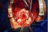Akut Aort Diseksiyonlarında Cerrahi Tedavi