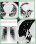 Kas Koruyucu Torakotomiler 1. Anterolateral: Latissimus dorsi medial kenarın- Göğüs Cerrahisi Rauf Görür