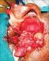 INVERTED PAPILLOMA AND ITS SURGICAL MANAGEMENT