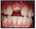 Cumhuriyet Dental Journal. Endodontic and orthodontic treatment approaches of traumatized teeth