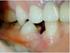 Dental Ankiloz: Tedavi Seçenekleri