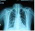 Perkütan karaciğer biyopsisi ile tanısı konulan multiorgan tutulumlu alveolar hidatik hastalığı olgusu