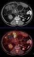 İki Intramusküler Lipom Olgusu: Radyolojik Bulgular Two Intramuscular Lipoma Case Reports: Radiological Findings