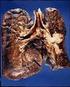 Akciğer Adenokarsinomlu Olguların Sigara Öyküsüne Göre Özellikleri