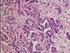 İğsi Hücreli Lipomun Histolojik Özellikleri ve Ayırıcı Tanı Problemleri