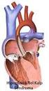 TANIM En sık görülen siyanotik konj. Kalp hastalığı Patolojik anatomi 4 bileşenden oluşur;